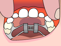 Gallery Image #126 - images/palatal-expander/palatal-expander-step1.gif