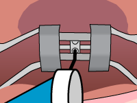 Gallery Image #128 - images/palatal-expander/palatal-expander-step3.gif