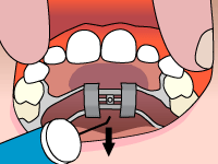Gallery Image #129 - images/palatal-expander/palatal-expander-step4.gif