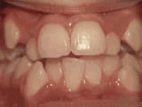 Gallery Image #40 - images/photos/orthodontic-treatments/crowding-of-the-teeth-before.jpg