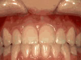 Gallery Image #55 - images/photos/orthodontic-treatments/openbite-after.jpg