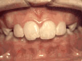 Gallery Image #58 - images/photos/orthodontic-treatments/overbite-before.jpg