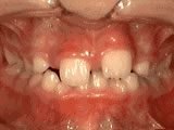 Gallery Image #60 - images/photos/orthodontic-treatments/phase-1-before.jpg