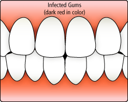 Gallery Image #65 - images/photos/periodontics/gingivitis.gif