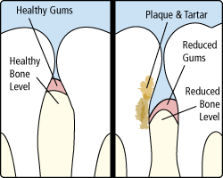 Gallery Image #67 - images/photos/periodontics/periodontitis.gif