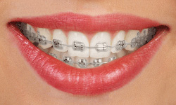 Gallery Image #134 - images/types-of-braces/traditional-metal.jpg