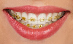 Gallery Image #131 - images/types-of-braces/gold.jpg