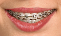 Gallery Image #133 - images/types-of-braces/self-ligating-braces.jpg